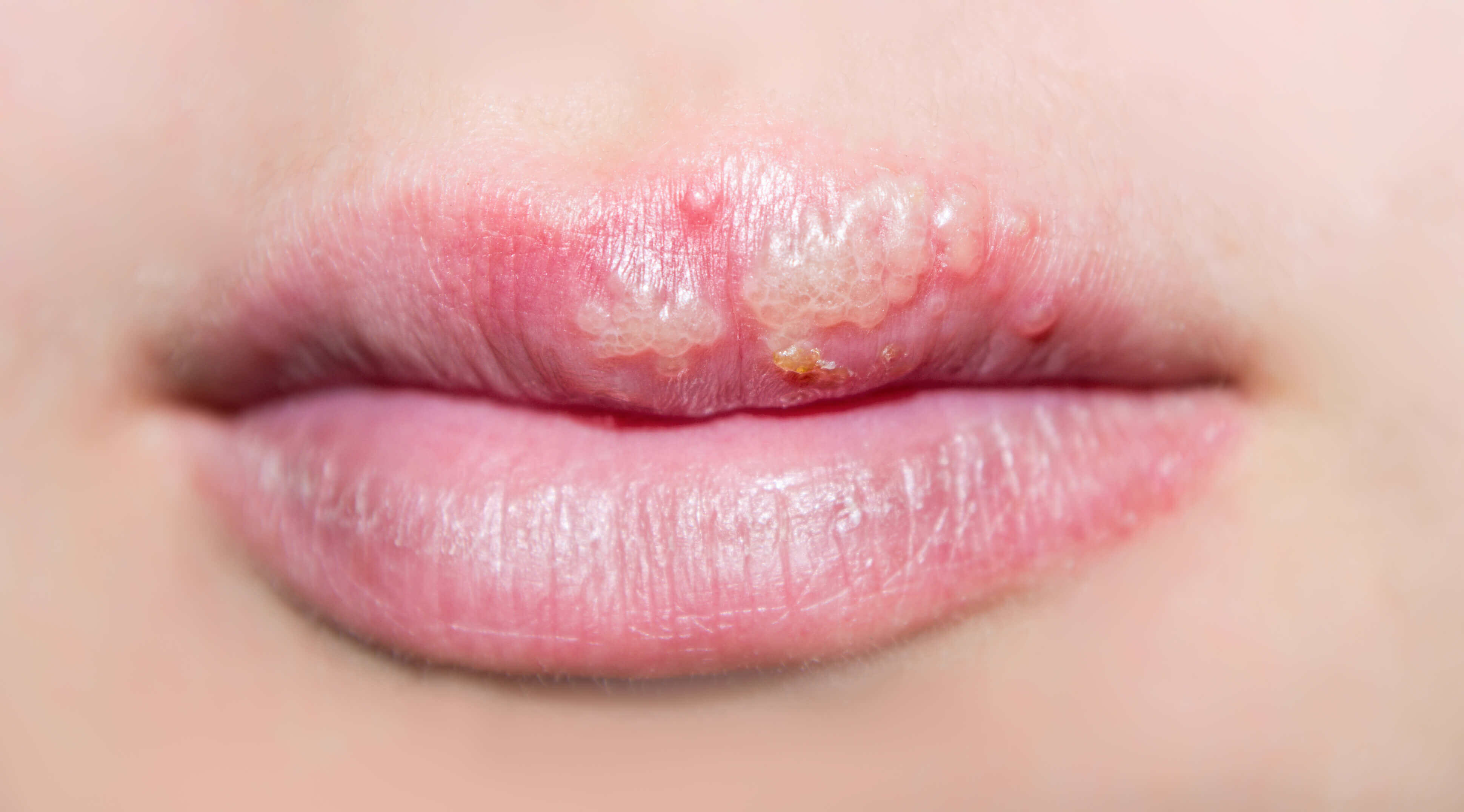Fastest way to get rid of cold sore on lip How To Get Rid Of A Cold Sore In 3 Days Flat Blog Huda Beauty