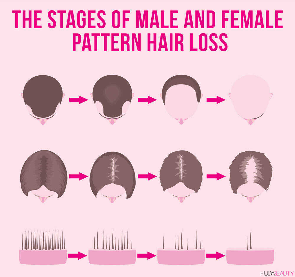 Hair Loss Causes, Signs and The Best Hair Loss Treatments   Blog ...