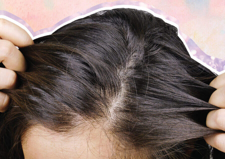 A Derm Reveals How To Fix Hormone-Related Hair Loss | Blog | HUDA BEAUTY