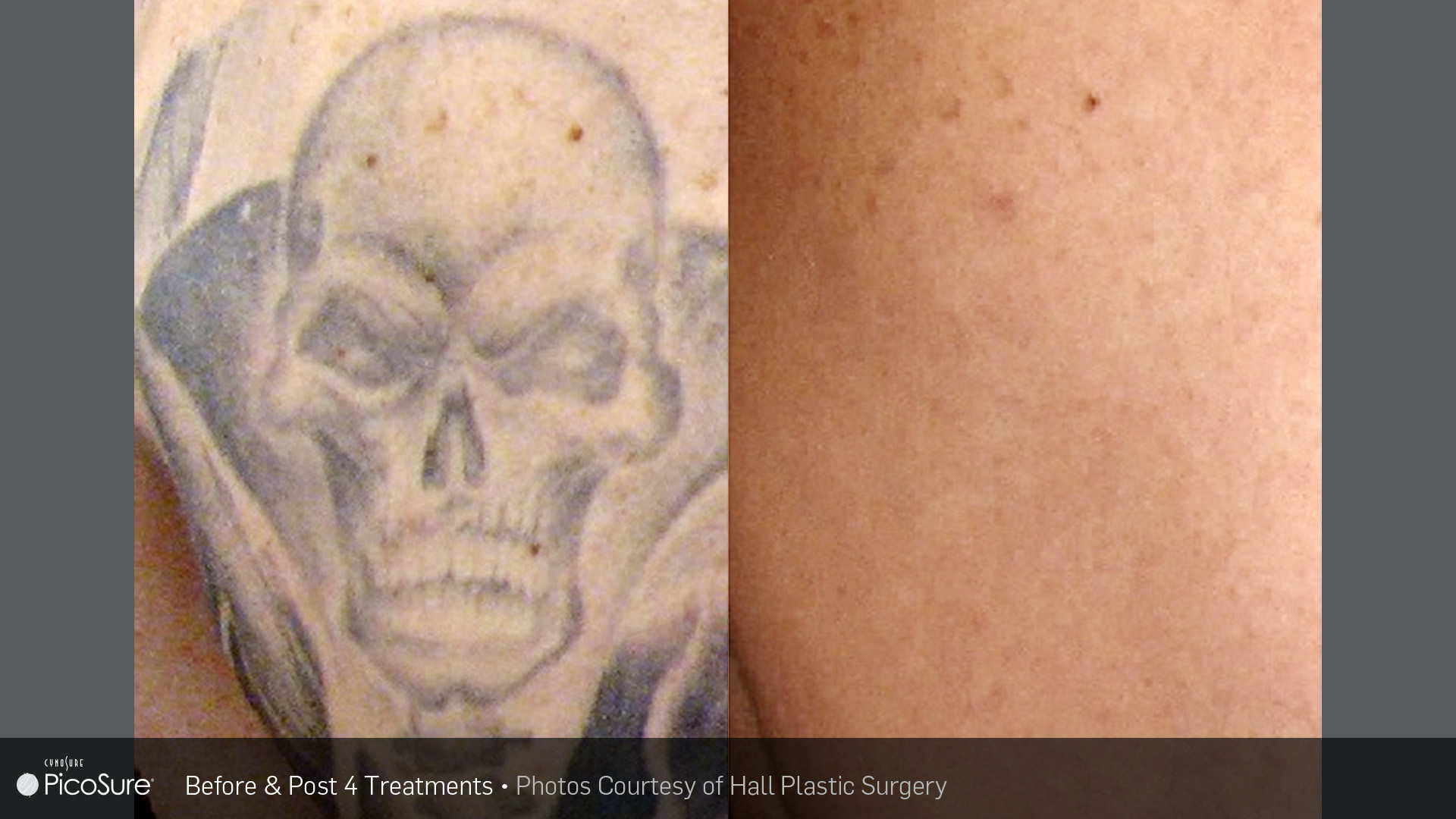 Tattoo Removal - Before and After Images