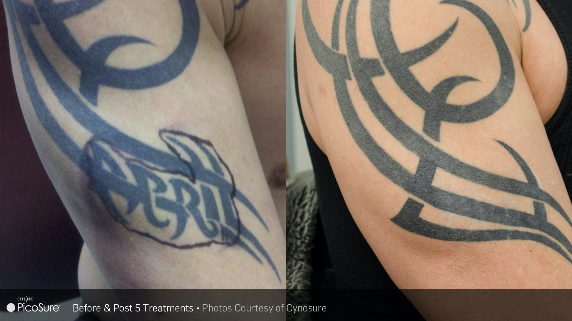 Tattoo Removal - Before and After Images