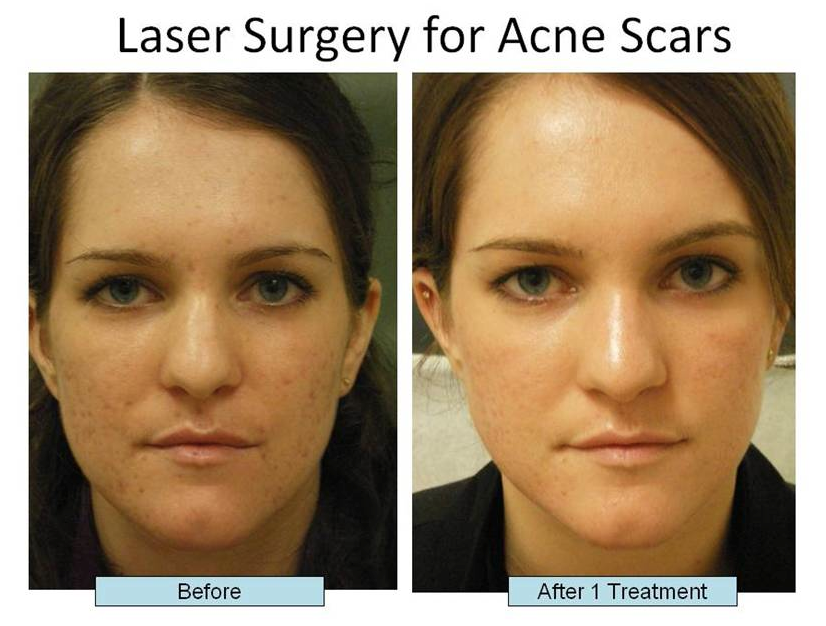 Brokke sig antenne amplifikation Laser Treatments For Acne Scars | Schweiger Dermatology Group