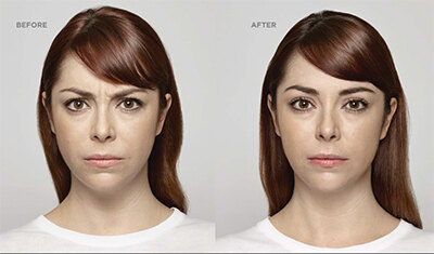 Before and after images of female patient who successfully underwent Dysport for wrinkles.