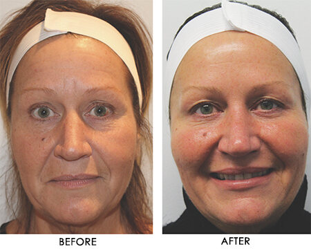 Before and after images of a female patient who successfully underwent Restylane Dermal filler treatment.