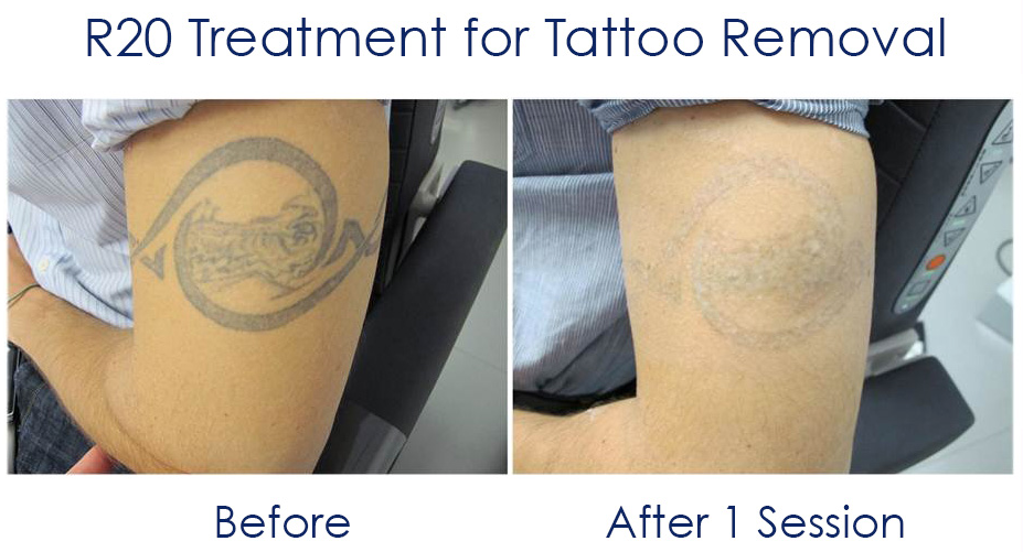 R20 tattoo removal before and after pictures