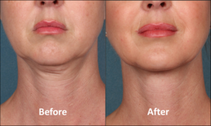 Before and after images of a female patient who successfully underwent non-surgical fat reduction of her chin using Kybella treatment.
