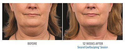 Before and after 12 weeks images of a female patient who successfully underwent Coolsculpting for Double Chin.