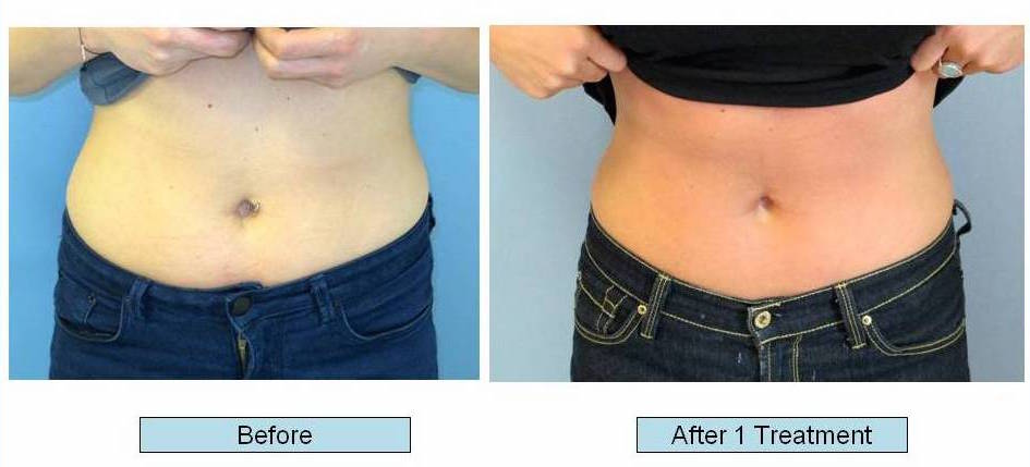 Before and after 1 treatment images of a female patient who successfully underwent non- surgical fat reduction of her stomach using CoolSculpting treatment.