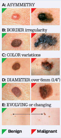 abcde-of-melanoma
