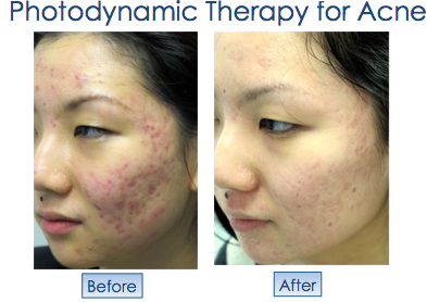 Before (left) and after (right) face images of Photodynamic Therapy for Acne.