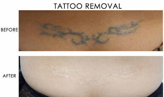 Before (Top) and after (Bottom) images of laser tattoo removal on the waist.