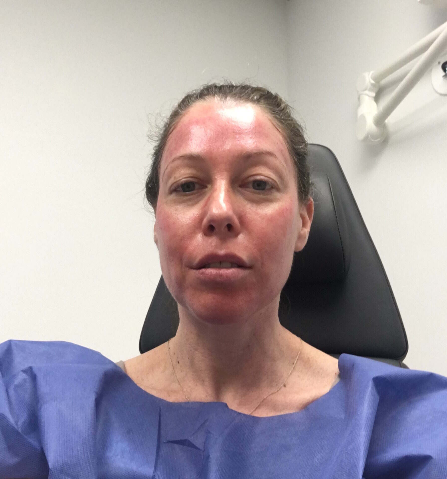 female happy after getting microneedling treatment