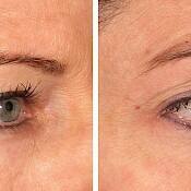 Before and after images of a female patient who successfully underwent laser treatment to remove wrinkles around her eyes.