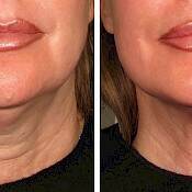 Before and after images of a female patient who successfully underwent laser treatment to remove wrinkles for her neck.