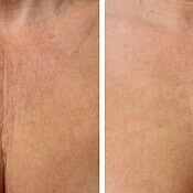 Before and after images of a female patient who successfully underwent laser treatment to remove wrinkles for her chest area.