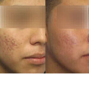 Laser Resurfacing for Acne Scars before & after