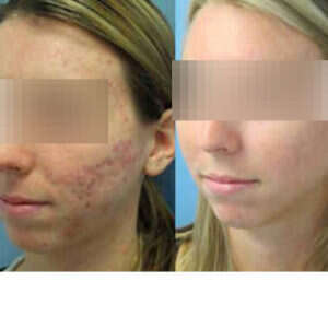 Laser Therapy for Acne Scars before & after