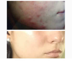 F.A.S.T. Acne Scar Treatment before & after