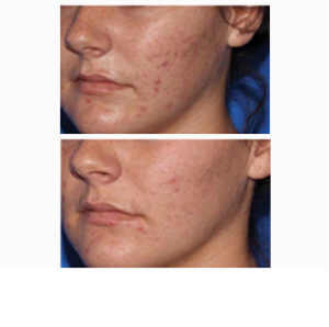 Laser Surgery for Acne Scars before & after