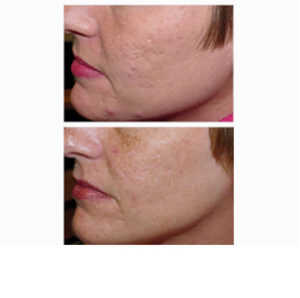 Laser Therapy for Acne before & after