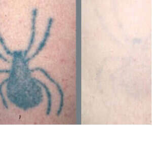 Laser Tattoo Removal before & after
