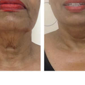 Facial Laser Resurfacing: Neck Damage before & after