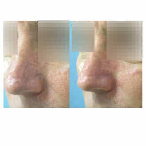 Laser Vein Removal before & after
