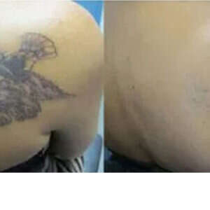 R20 Treatment for Tattoo Removal before & after