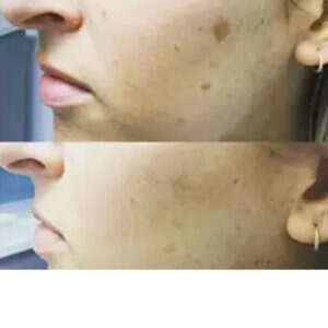 Laser Treatment for Mole Removal before & after
