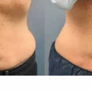 ZELTIQ Non-Surgical Fat Reduction before & after