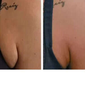 Bra Fat Removal before & after