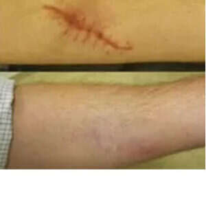 Fraxel Laser Treatment for Surgical Scar before & after