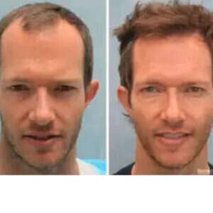 Hair Restoration before & after