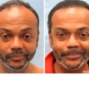 Hair Restoration before & after