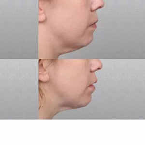 Fat Removal Kybella before & after