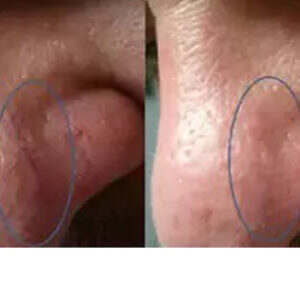 Laser Removal of Nose telangiectasia before & after