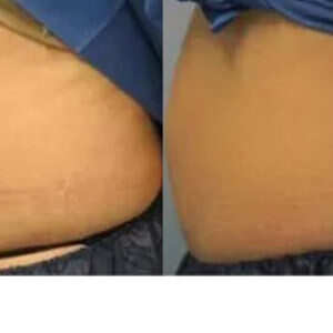 ZELTIQ Non-Surgical Fat Reduction before & after