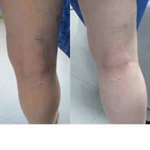Sclerotherapy for Leg Veins before & after