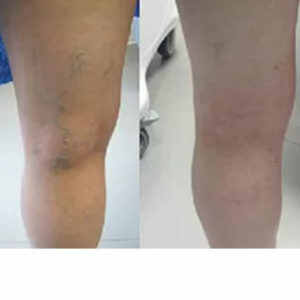 Sclerotherapy for Leg Veins before & after