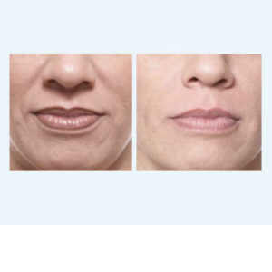 Botox Treatment at SDG before & after
