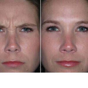 Botox for Facial Reshaping (Cheeks) before & after