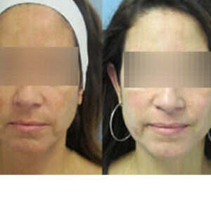 Melasma Treatment with Fraxel Dual before & after