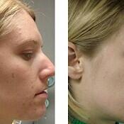 before and after images of best acne treatments - patient 1