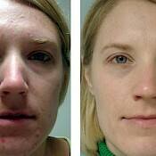 before and after images of best acne treatments - patient 10