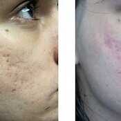 before and after images of best acne treatments - patient 11