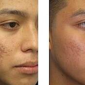 before and after images of best acne treatments - patient 2