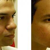 before and after images of best acne treatments - patient 3