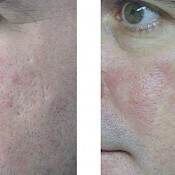 before and after images of best acne treatments - patient 5