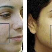before and after images of best acne treatments - patient 6