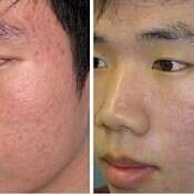 before and after images of best acne treatments - patient 7